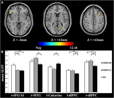 Increased Salience Network Activity in Patients With Insomnia Complaints in Major Depressive Disorder